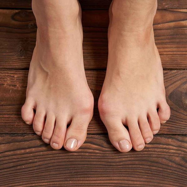 How Bunions Affect Your Ability to Walk and Run